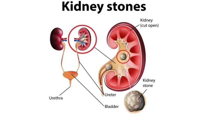 kidney stone pain in clitorus