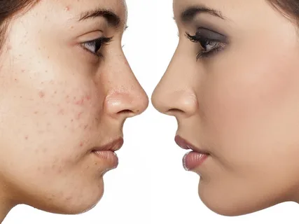 acne scar treatment