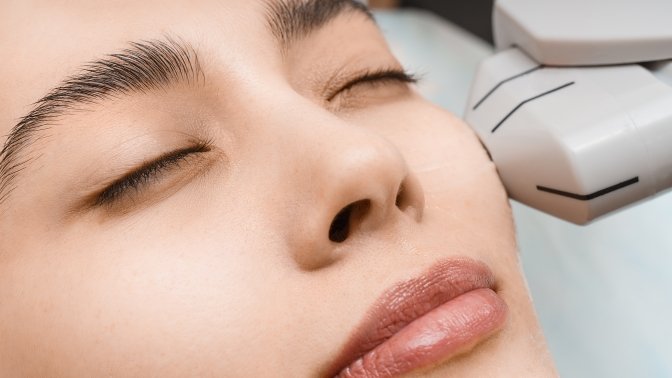 Melasma Singapore: Can It Be Permanently Cured By Laser?